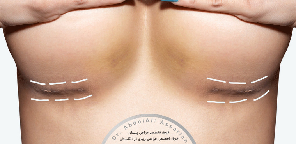 جای-زخم-بعد-از-جراحی-پستان