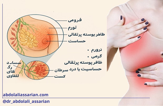 سرطان سینه التهابی