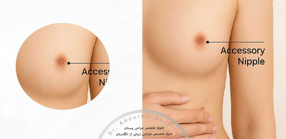 پستان فرعی چیست